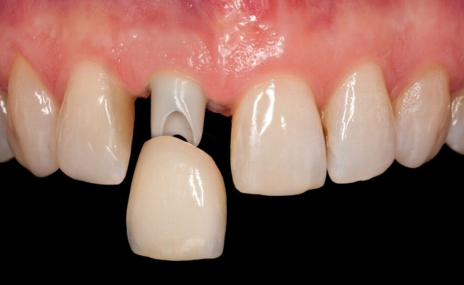 Dental-Crowns-30.jp